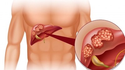 Cà gai leo: Cây thuốc quý điều trị bệnh gan